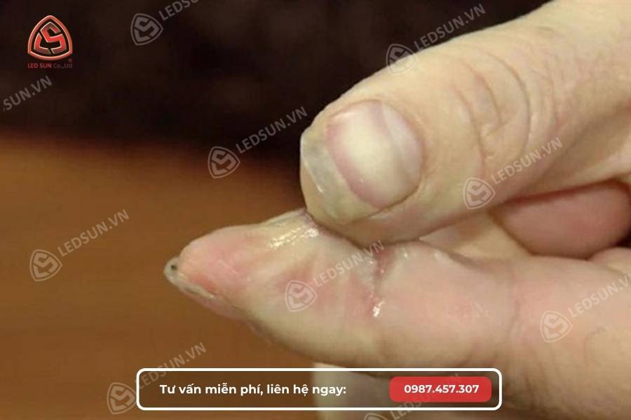 Bị keo 502 dính vào tay có sao không?